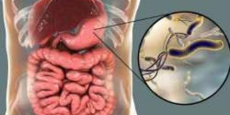 أعراض خفية وطرق شائعة وراء الإصابة بمرض جرثومة المعدة.. سعود الشهرى يوضح - بوابة فكرة وي