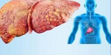 أخبار الرياضة - ماذا نعرف عن مرض الكبد الدهني وأسبابه؟.. تقارير طبية تُجيب - بوابة فكرة وي
